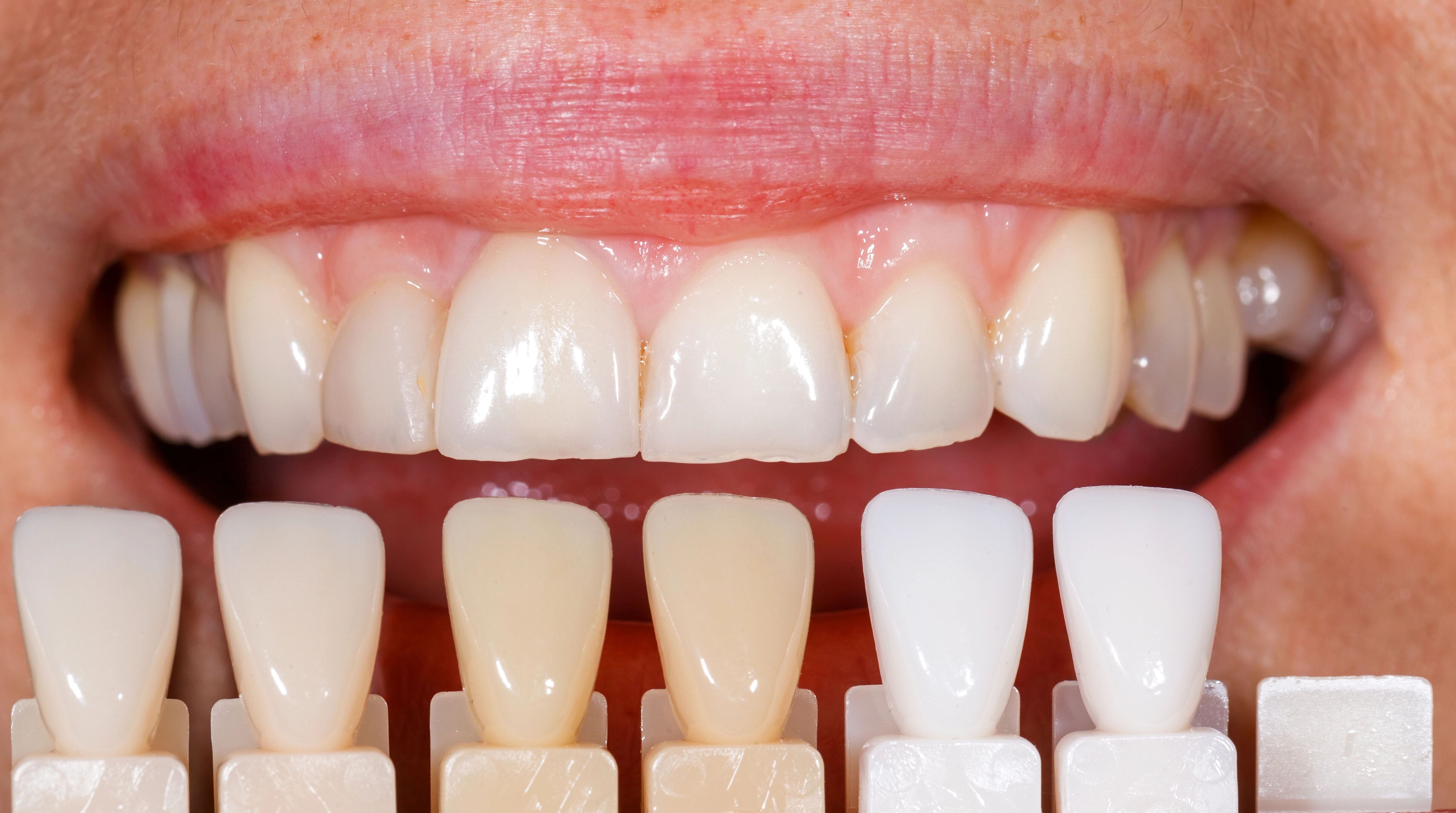 Veneer Cost: What You Should Expect to Pay